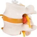 Fabrication Enterprises 3B® Anatomical Model - 2 Lumbar Vertebrae with Prolapsed Disc, Flexibly Mounted 984665
